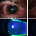 The Truth About UV Light: Harmful or Helpful?